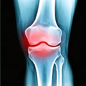 ¿Qué es la artrosis y cómo afecta a la salud?